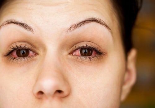 Why have i suddenly become allergic to eyelash extensions?