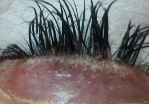 Why do lash extensions fall out?