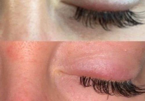 What soothes irritated eyes from eyelash extensions?